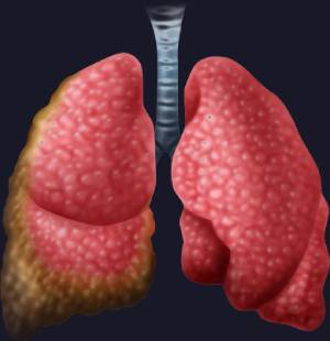 mesotheolioma lungs